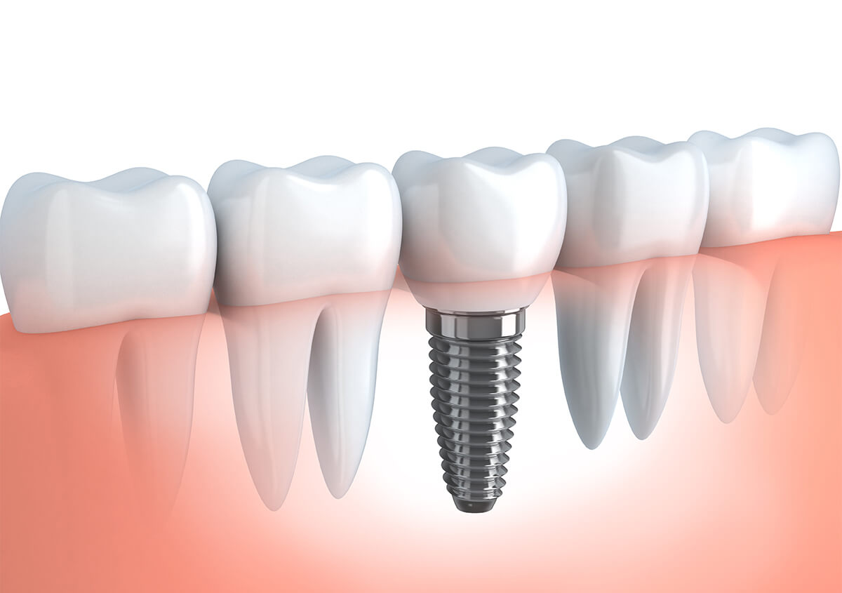 Dental Implant Procedure in Richardson TX Area
