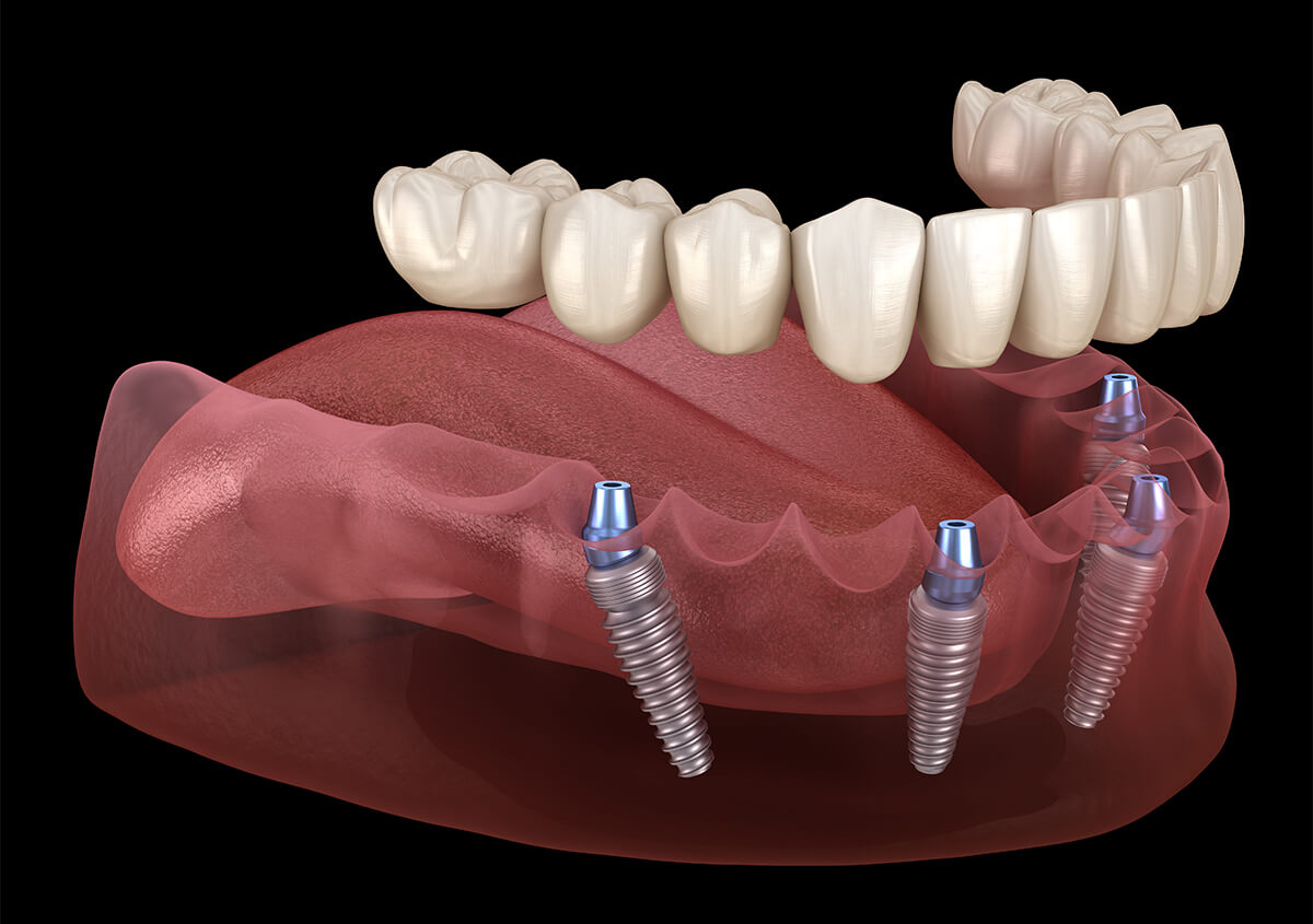 All on 4 Dental Implants in Richardson TX Area
